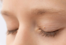 Everything You Need to Know About Removing Eye Skin Tags