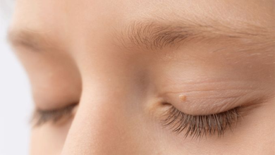 Everything You Need to Know About Removing Eye Skin Tags