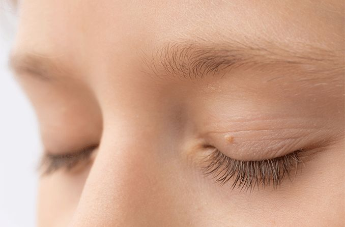 Everything You Need to Know About Removing Eye Skin Tags