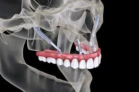 What Are Zygoma Implants How to Do